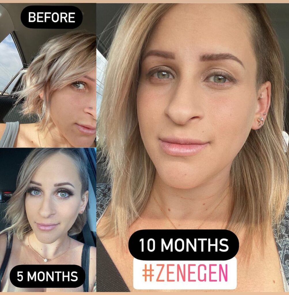 Zenagen before and after