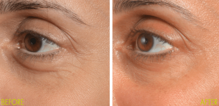 Nira Skincare Laser Before And After