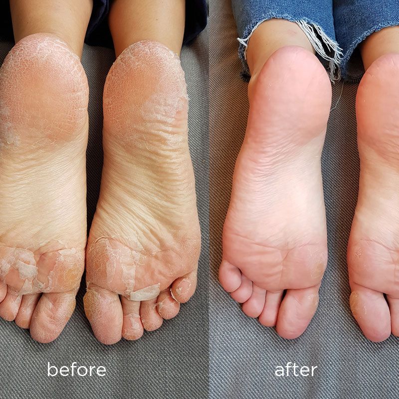 Whish Exfoliating Foot Mask before and after